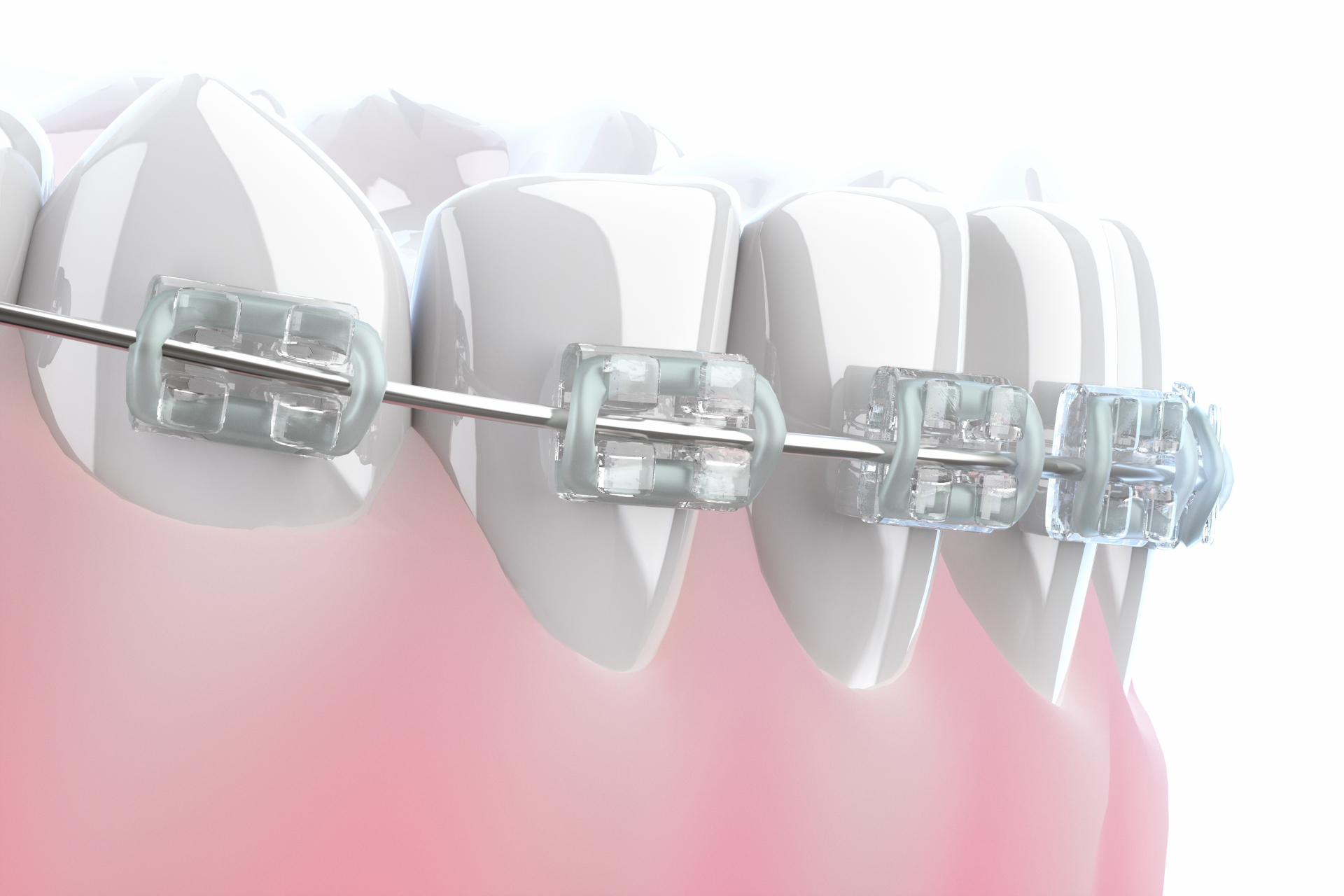 ワイヤー矯正で歯が治るのはなぜ？仕組みや矯正の流れを解説