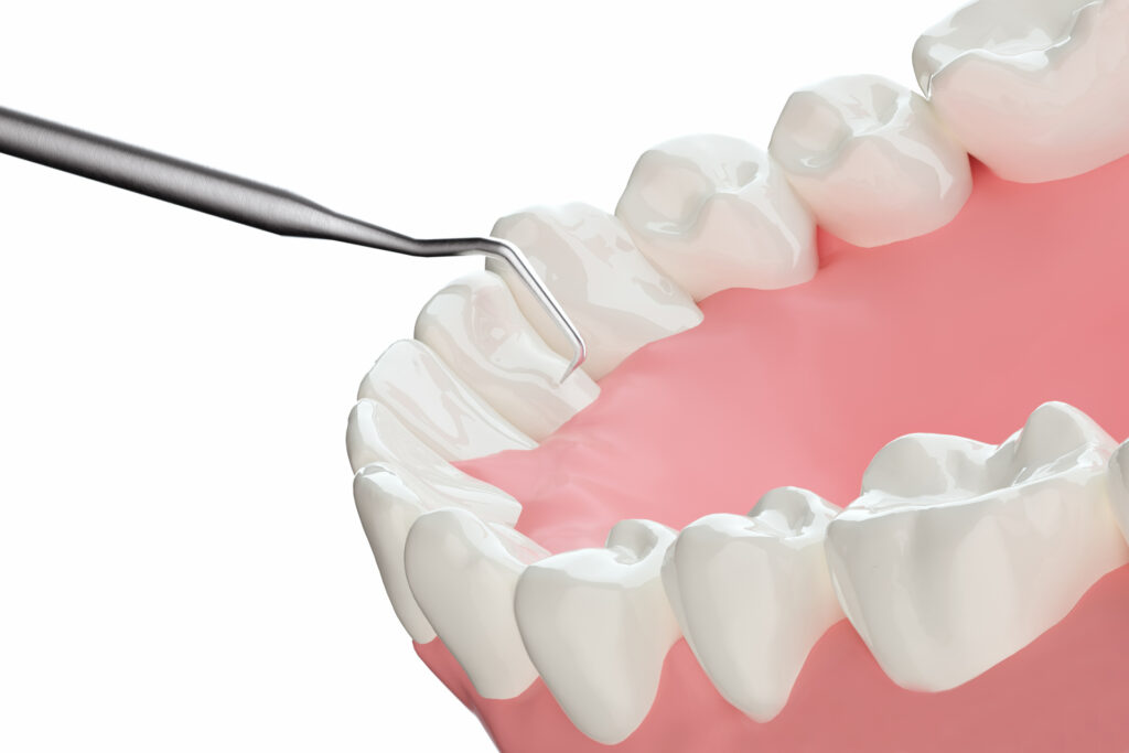 ガチャ歯の矯正方法