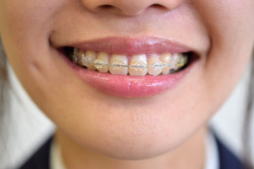 歯科矯正で美しい歯並びになる方法